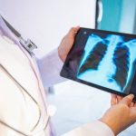 Novo estudo oferece esperança para pacientes com câncer de pulmão em estágio avançado